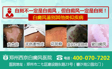 儿童早期白癜风有什么症状