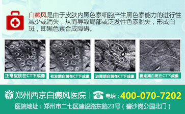 郑州白癜风哪家医院